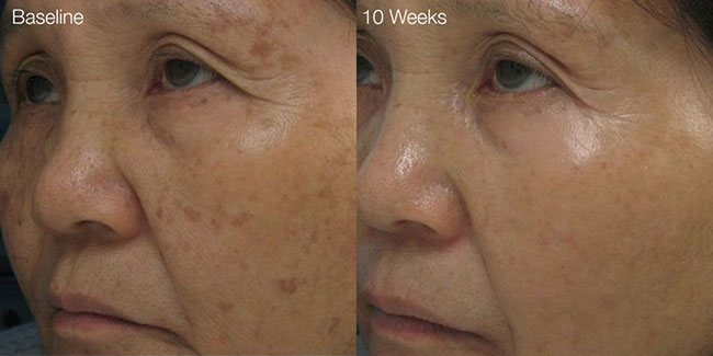 Before and after Dermalinfusion treatment