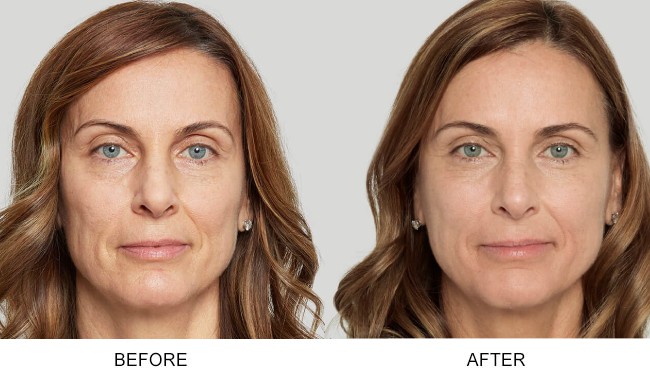 Before and after comparison with Sculptra